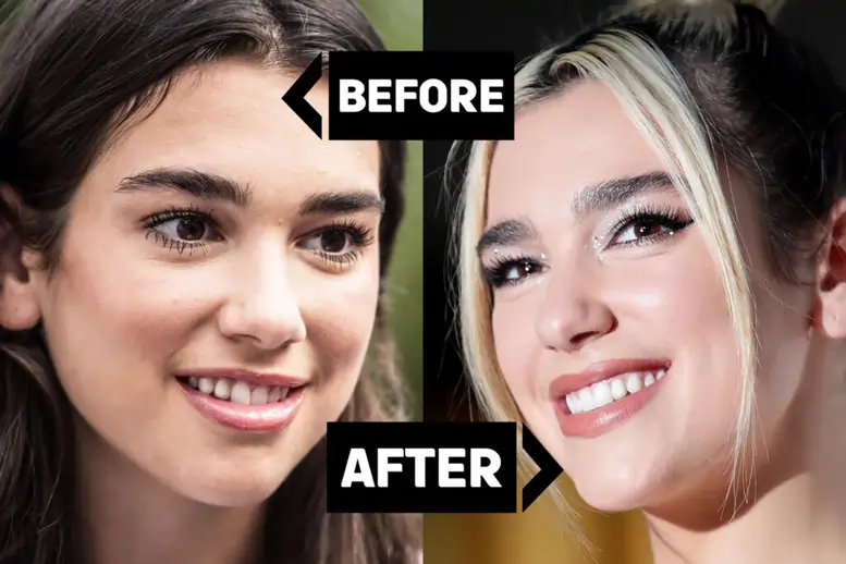 نتيجة تجميل الوجه — شد